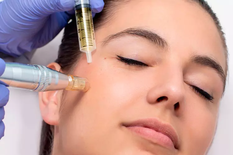 Dermapen or Microneedling