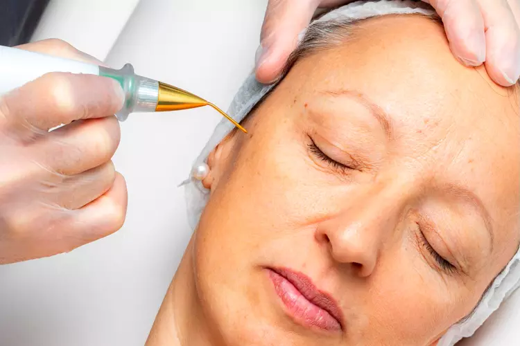 PlasmaPen or Plasmafibroblast