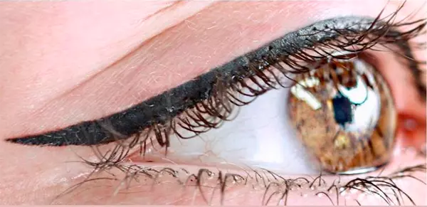 Eye micropigmentation.