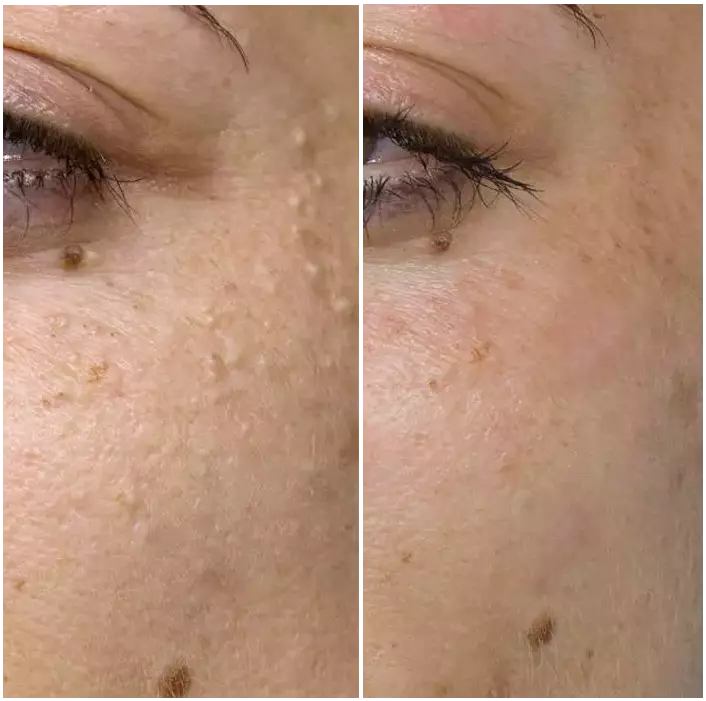 Remove imperfections with PlasmaPen.