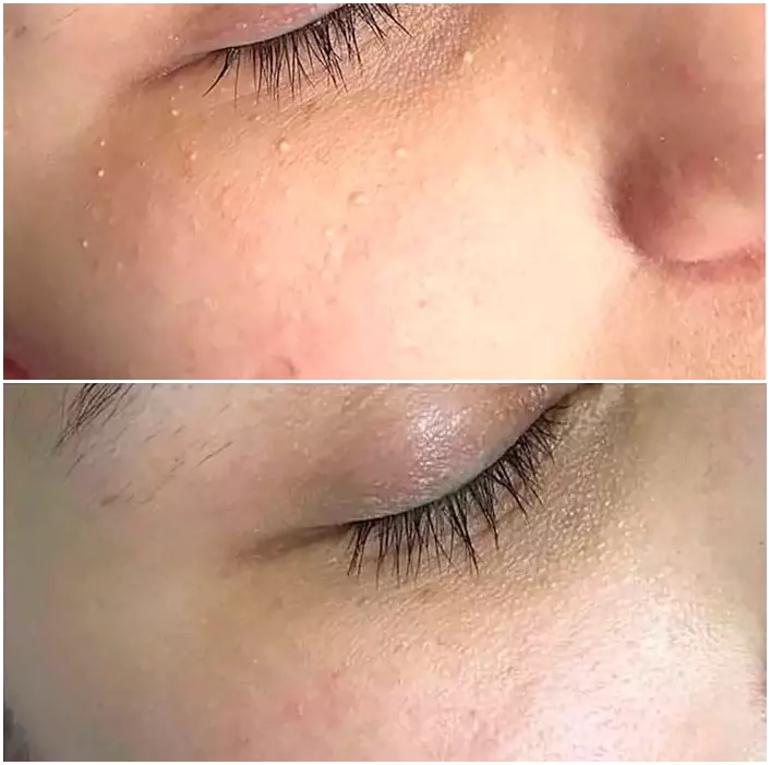 Facial treatment with PlasmaPen.